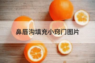 鼻唇沟填充小窍门图片